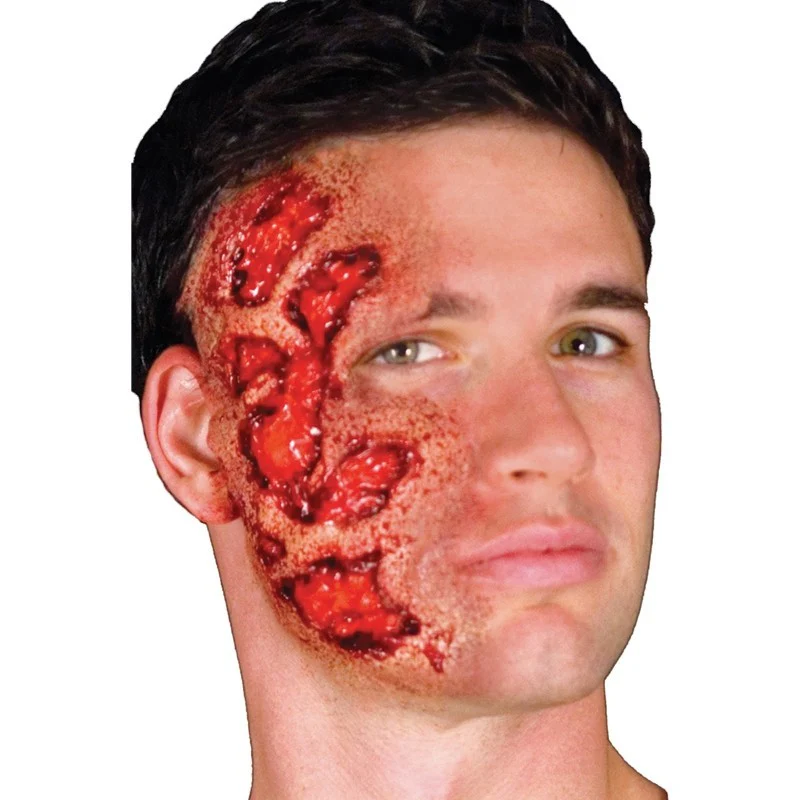 3-D Burns Prosthetic